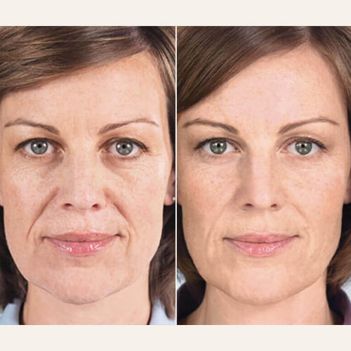 Sculptra Before and After Photos By Enchanted Medical Aesthetics