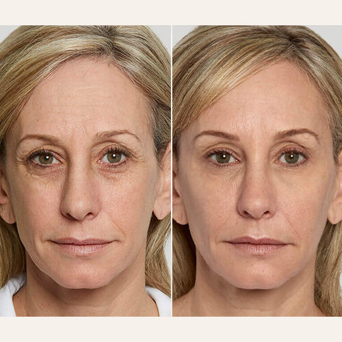 Sculptra Treatment Before and After By Enchanted Medical Aesthetics