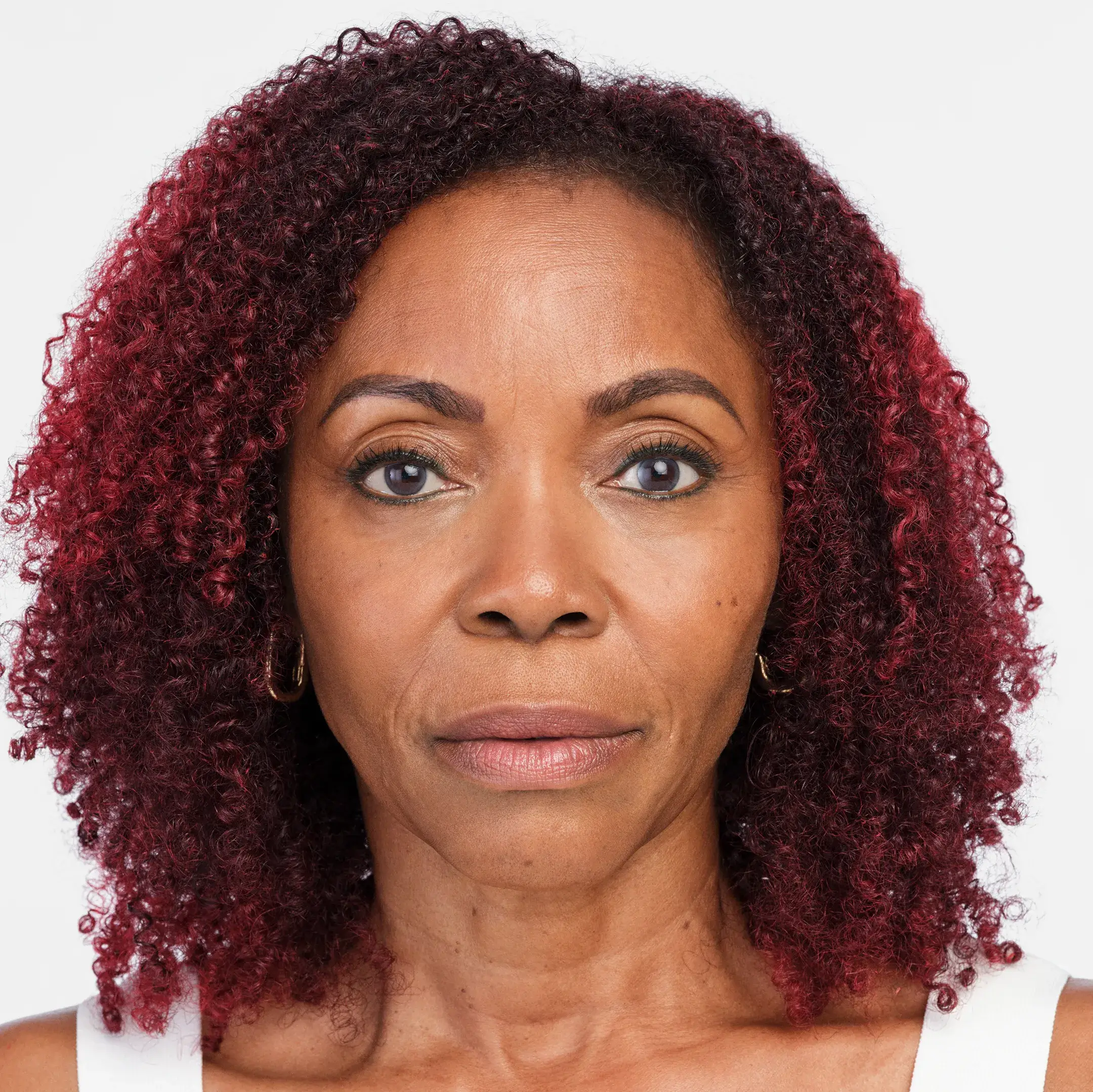 Radiesse Treatment After Photo By Enchanted Medical Aesthetics