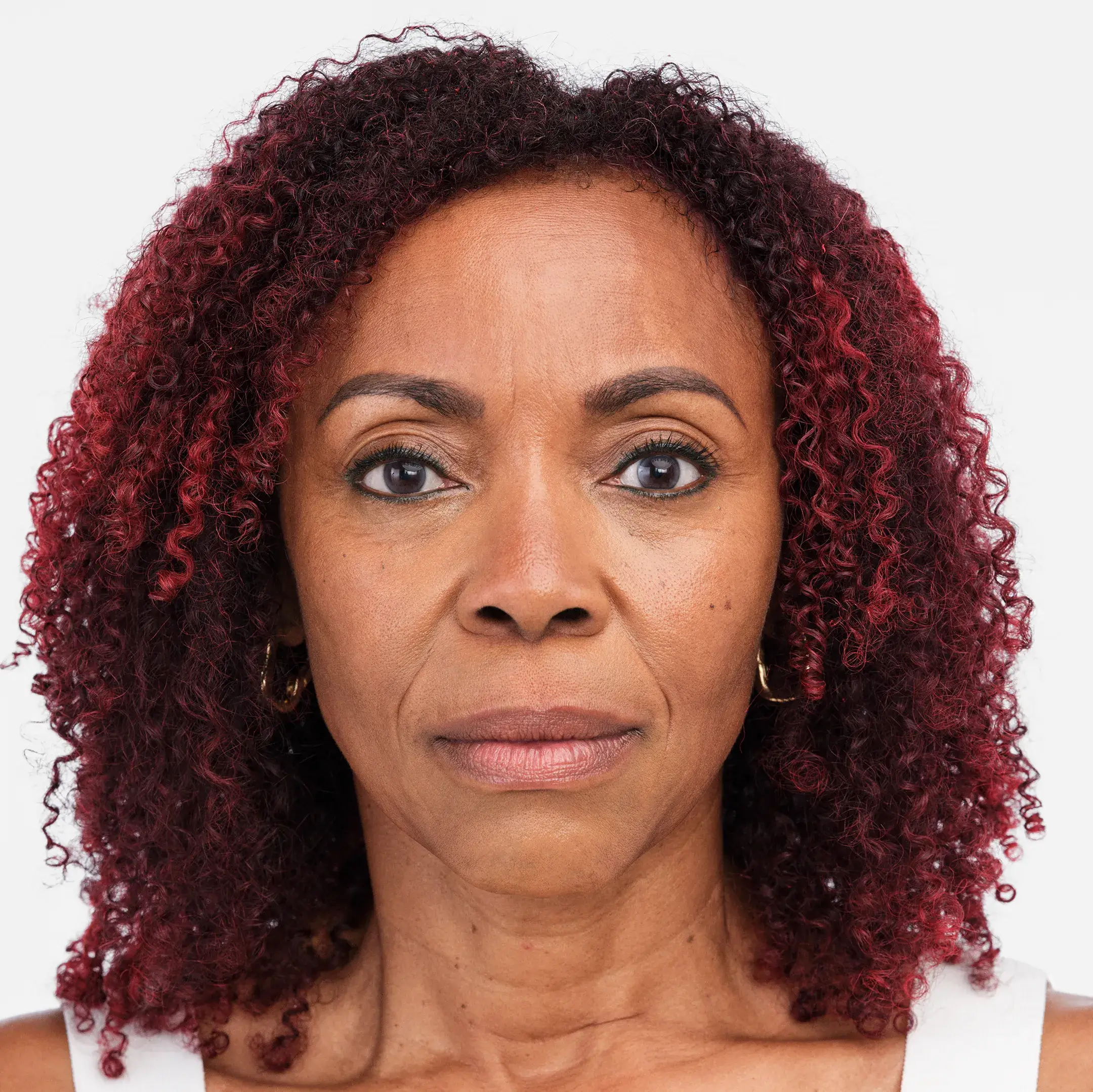 Radiesse Treatment Before Photo By Enchanted Medical Aesthetics