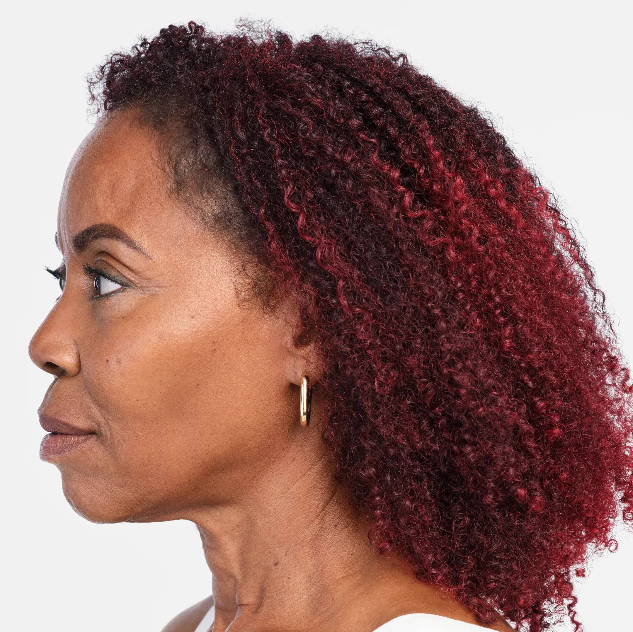Radiesse Treatment After Photo By Enchanted Medical Aesthetics