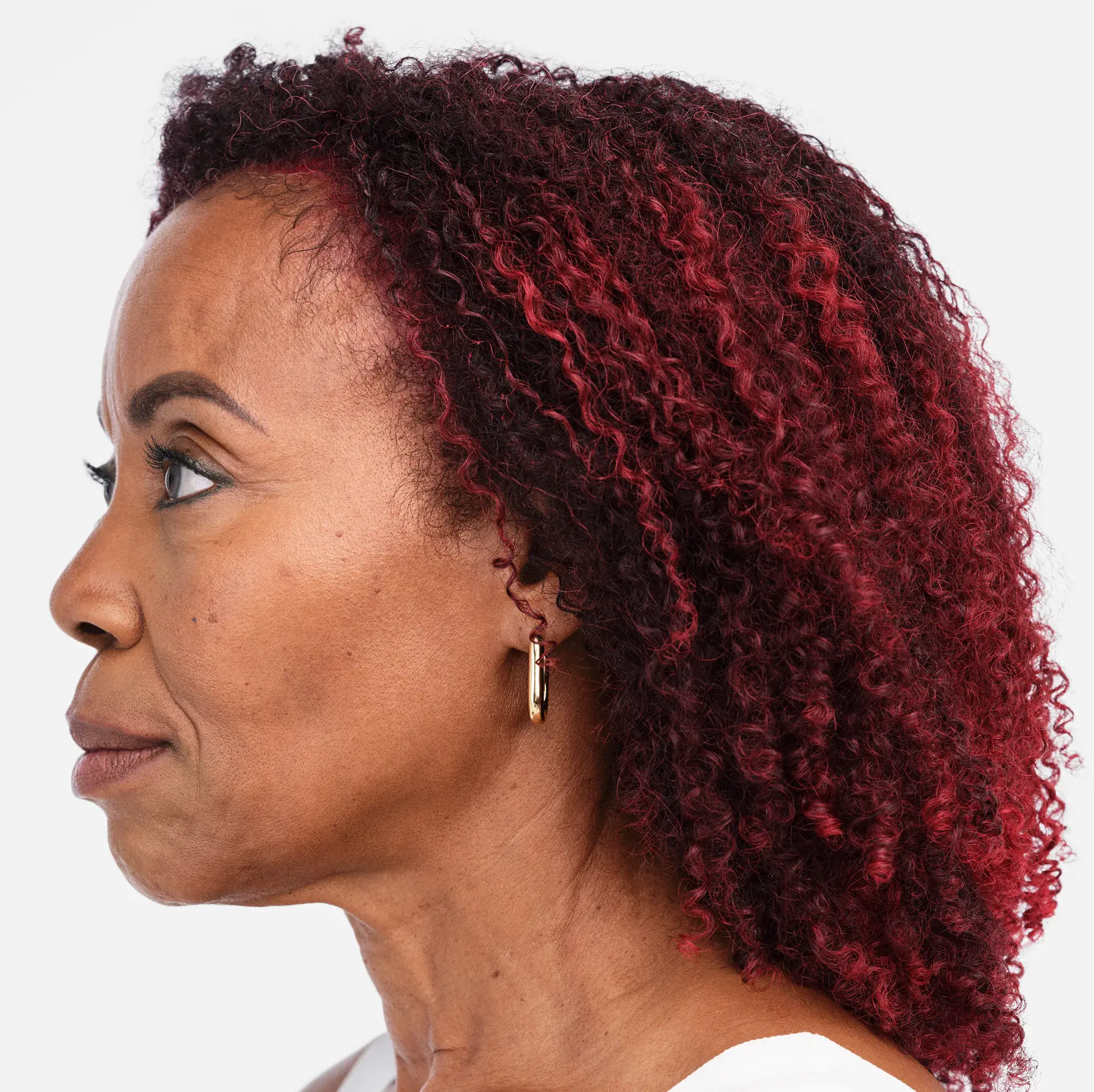 Radiesse Treatment Before Photo By Enchanted Medical Aesthetics