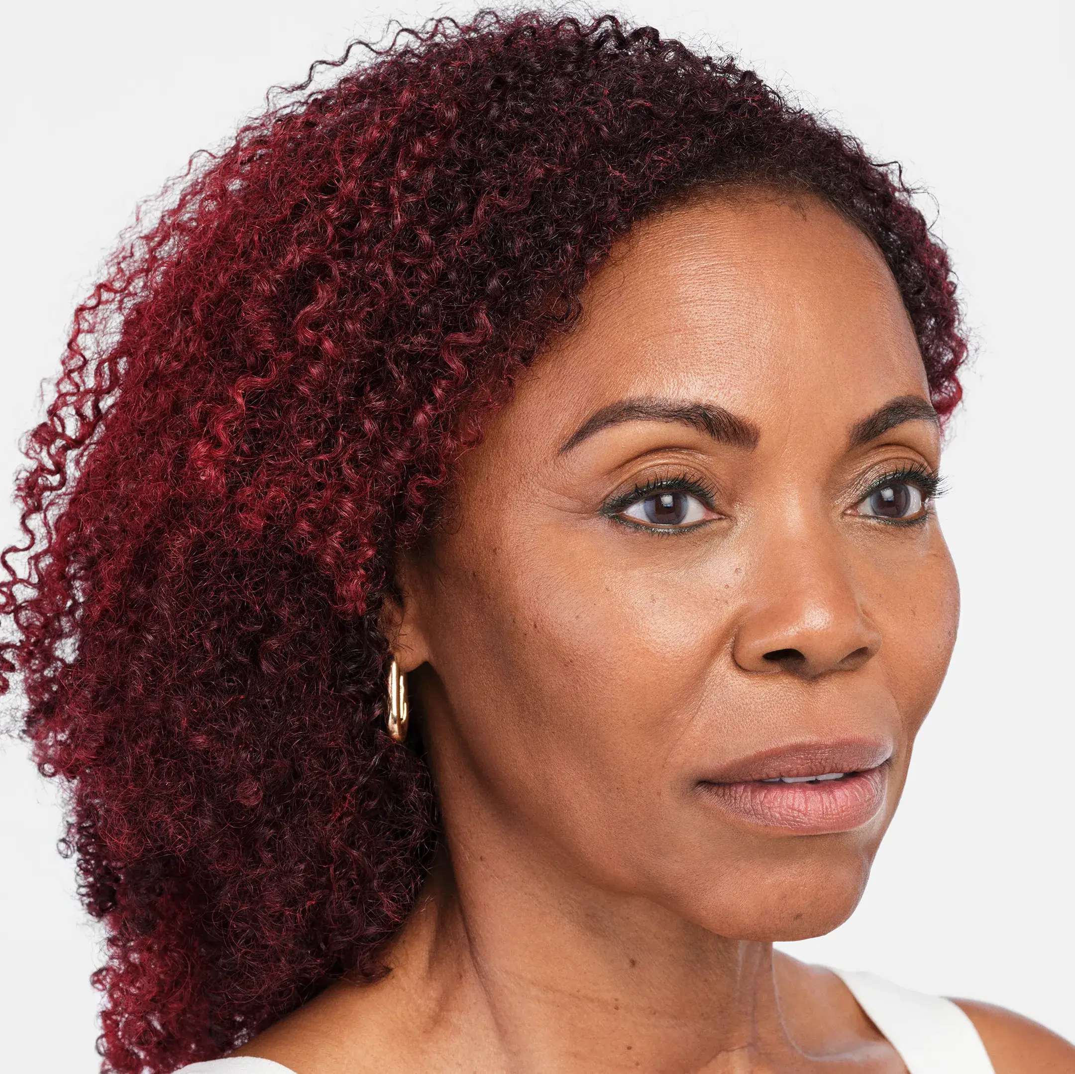 Radiesse Treatment After Photo By Enchanted Medical Aesthetics