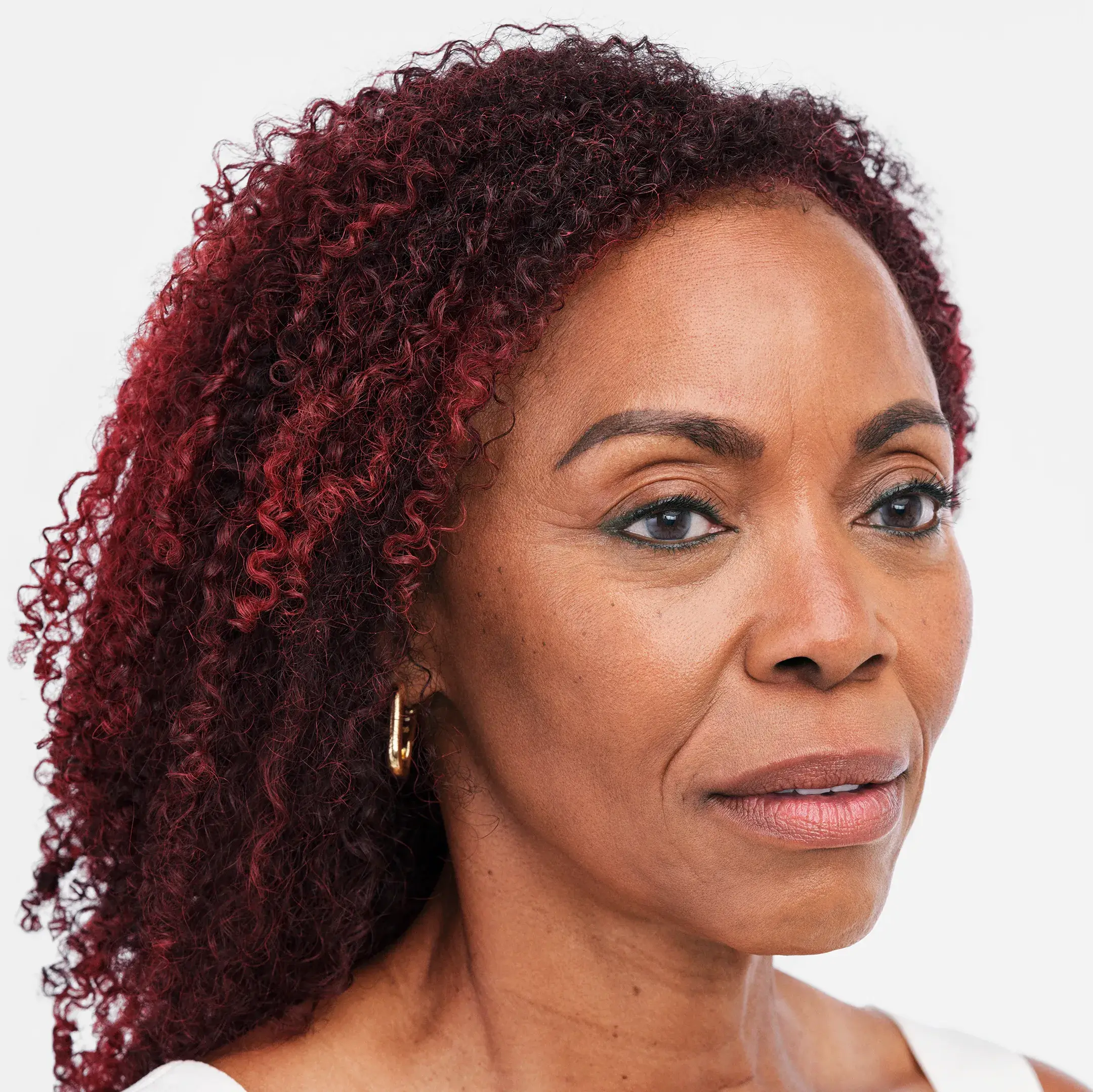 Radiesse Treatment Before Photo By Enchanted Medical Aesthetics