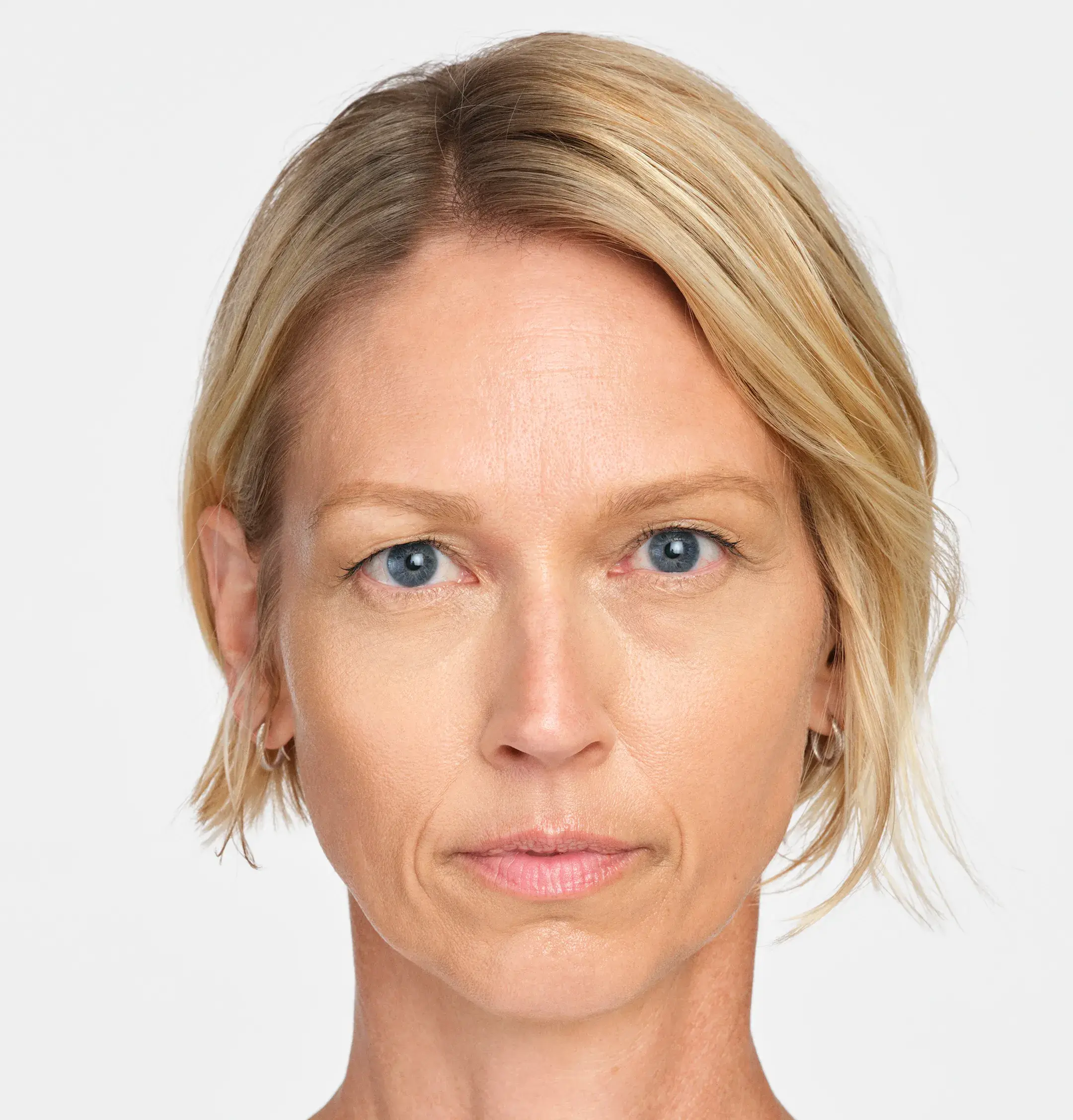Radiesse Treatment Before Photo By Enchanted Medical Aesthetics