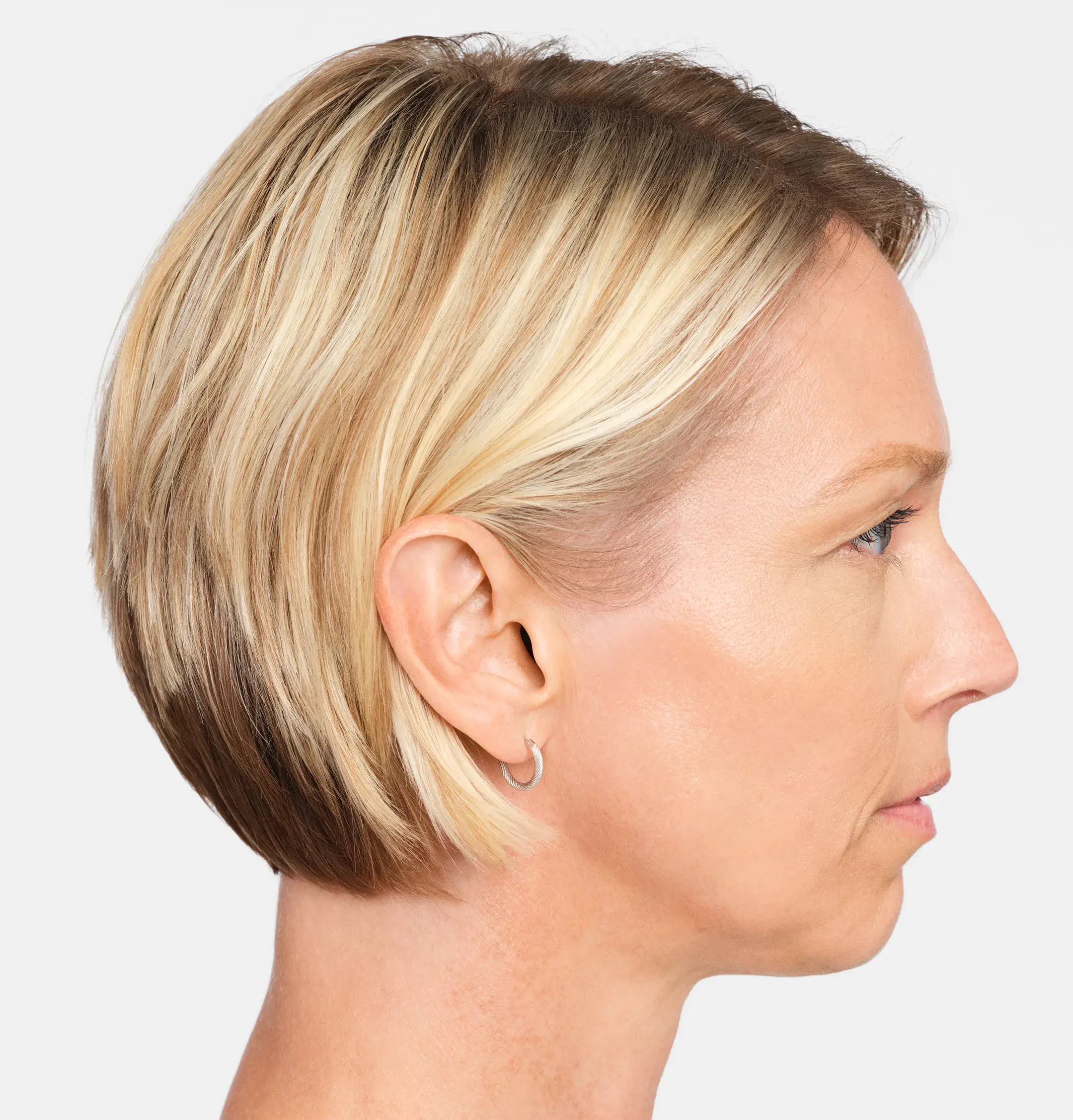Radiesse Treatment After Photo By Enchanted Medical Aesthetics