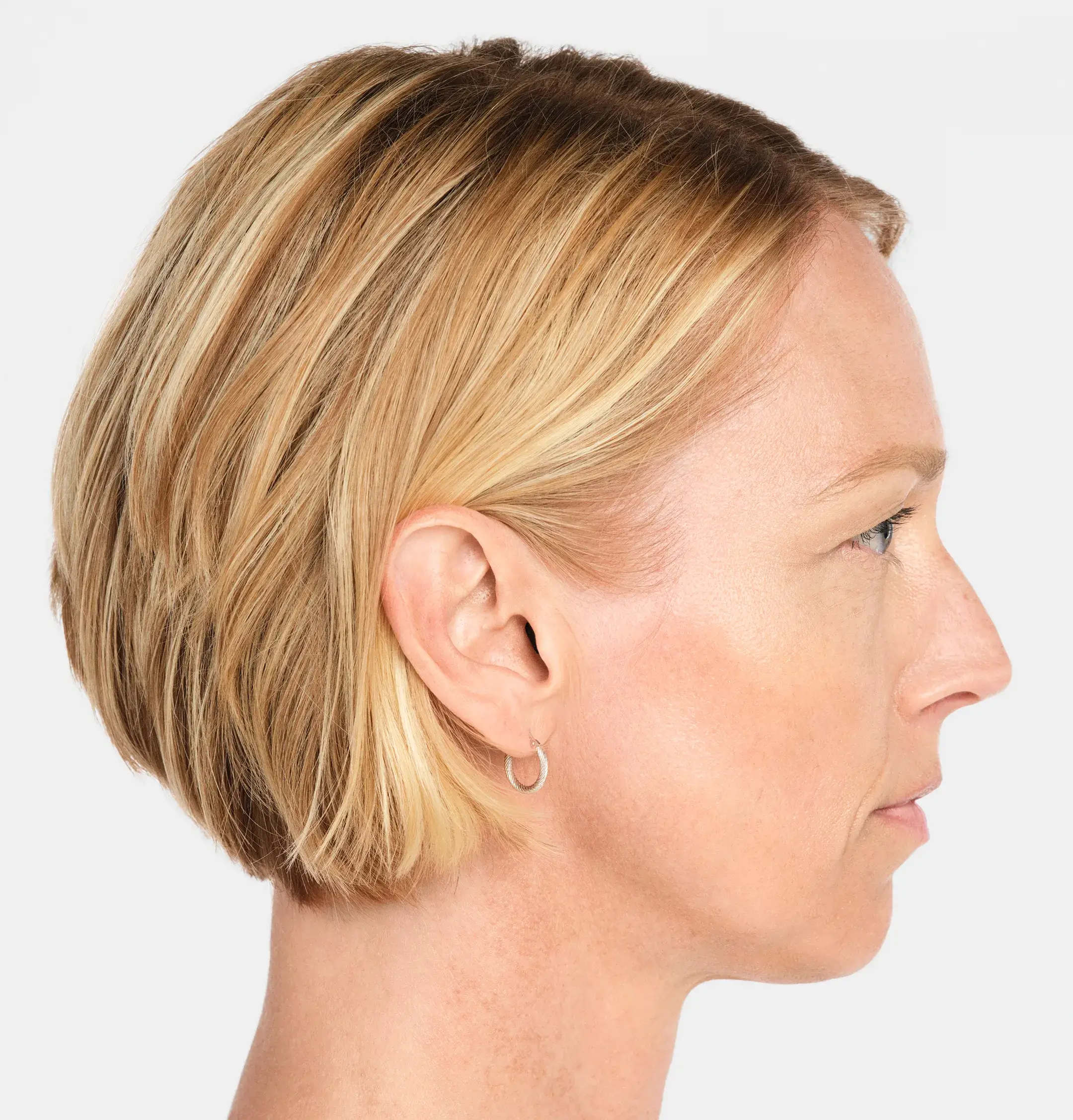 Radiesse Treatment Before Photo By Enchanted Medical Aesthetics