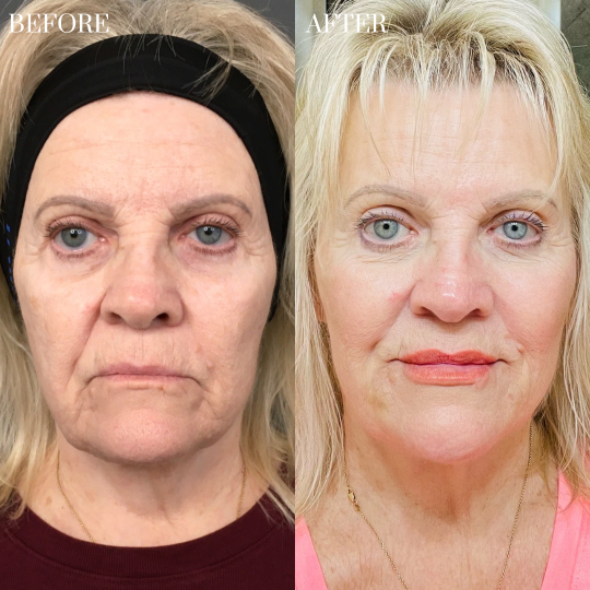 Liquid Facelift (1)