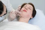 Risks or Side Effects of PDO Thread Lift
