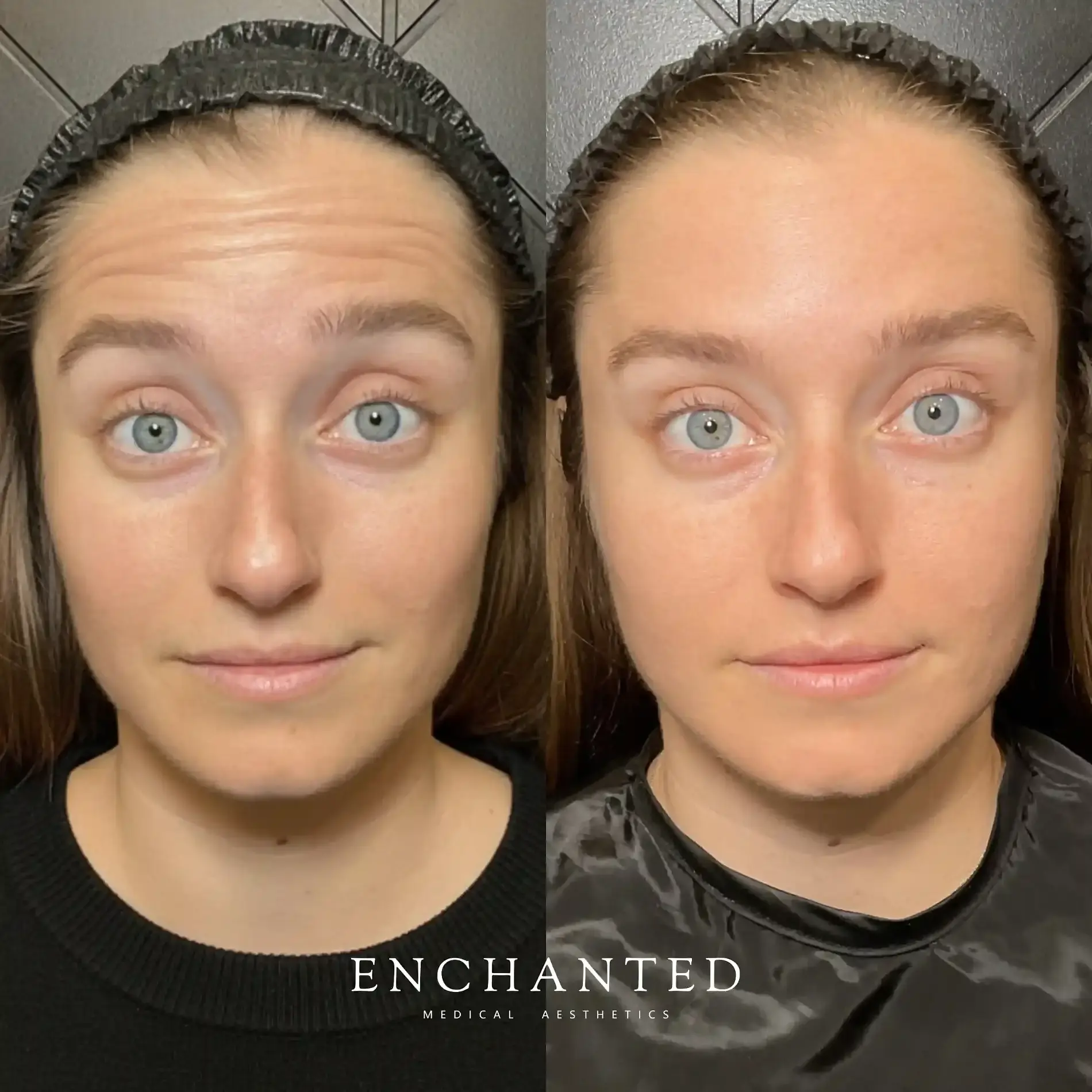 Botox Cosmetic Services in DeLand, FL FAQ Image one