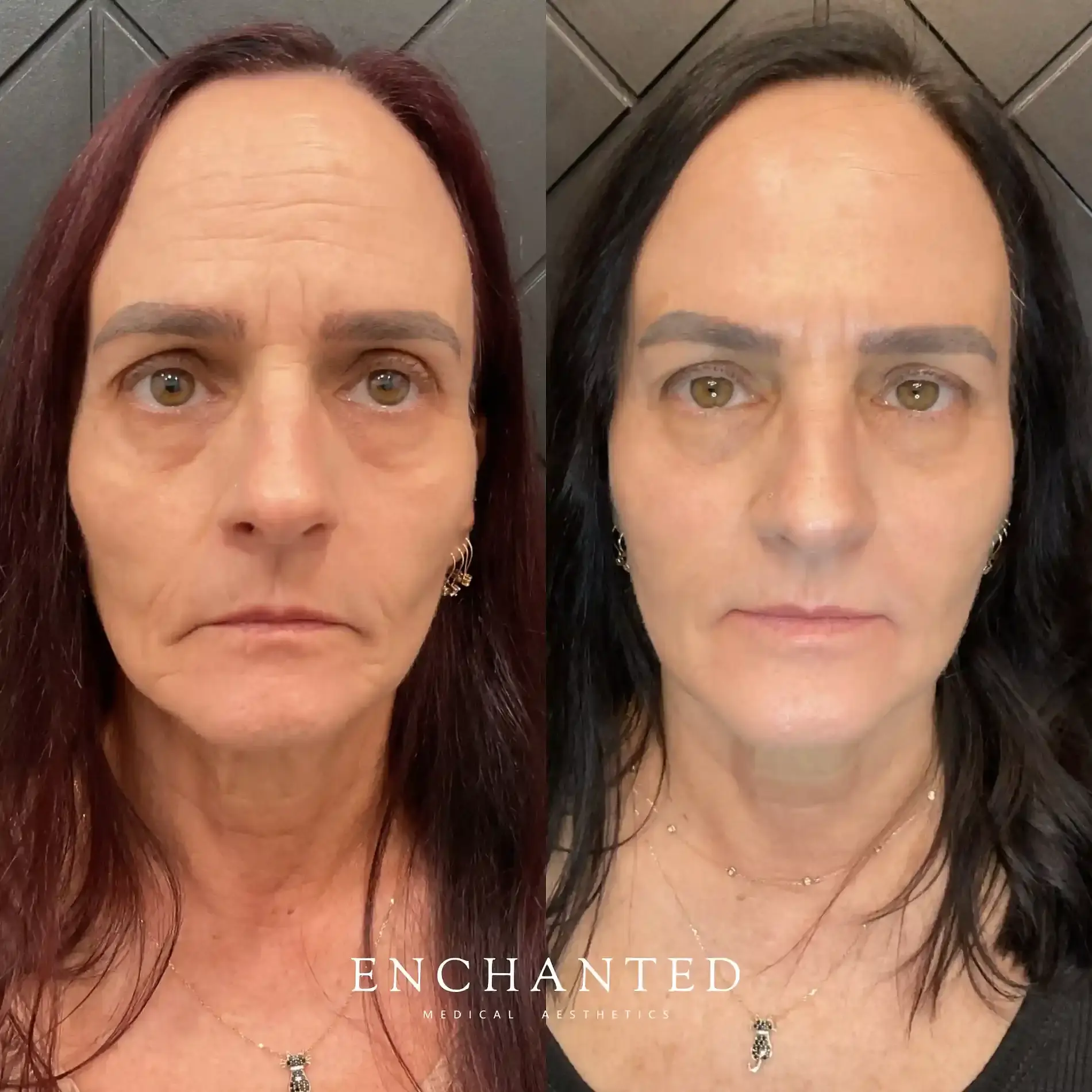 Botox Cosmetic Services in DeLand, FL FAQ Image three