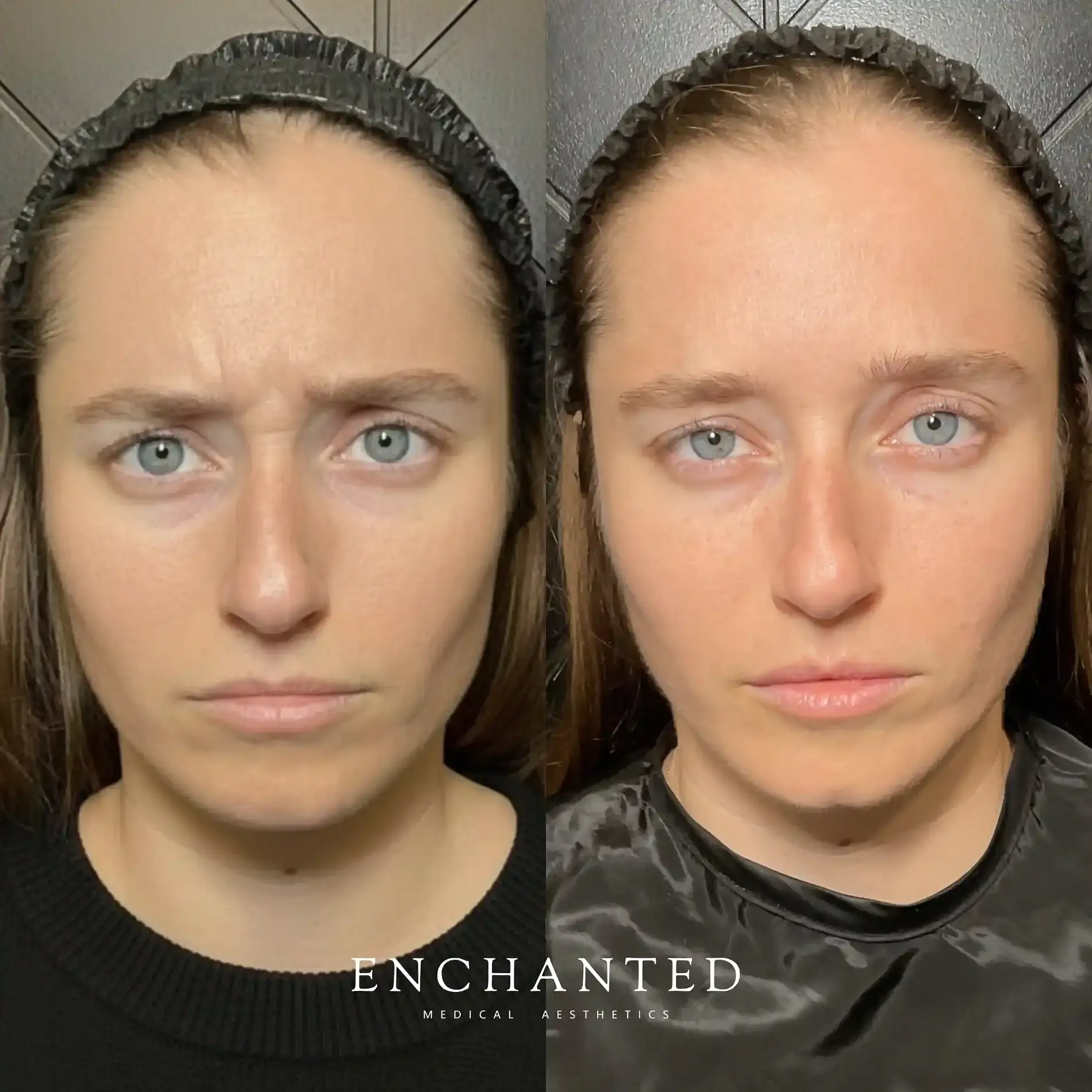 Botox Cosmetic Services in DeLand, FL FAQ Image two