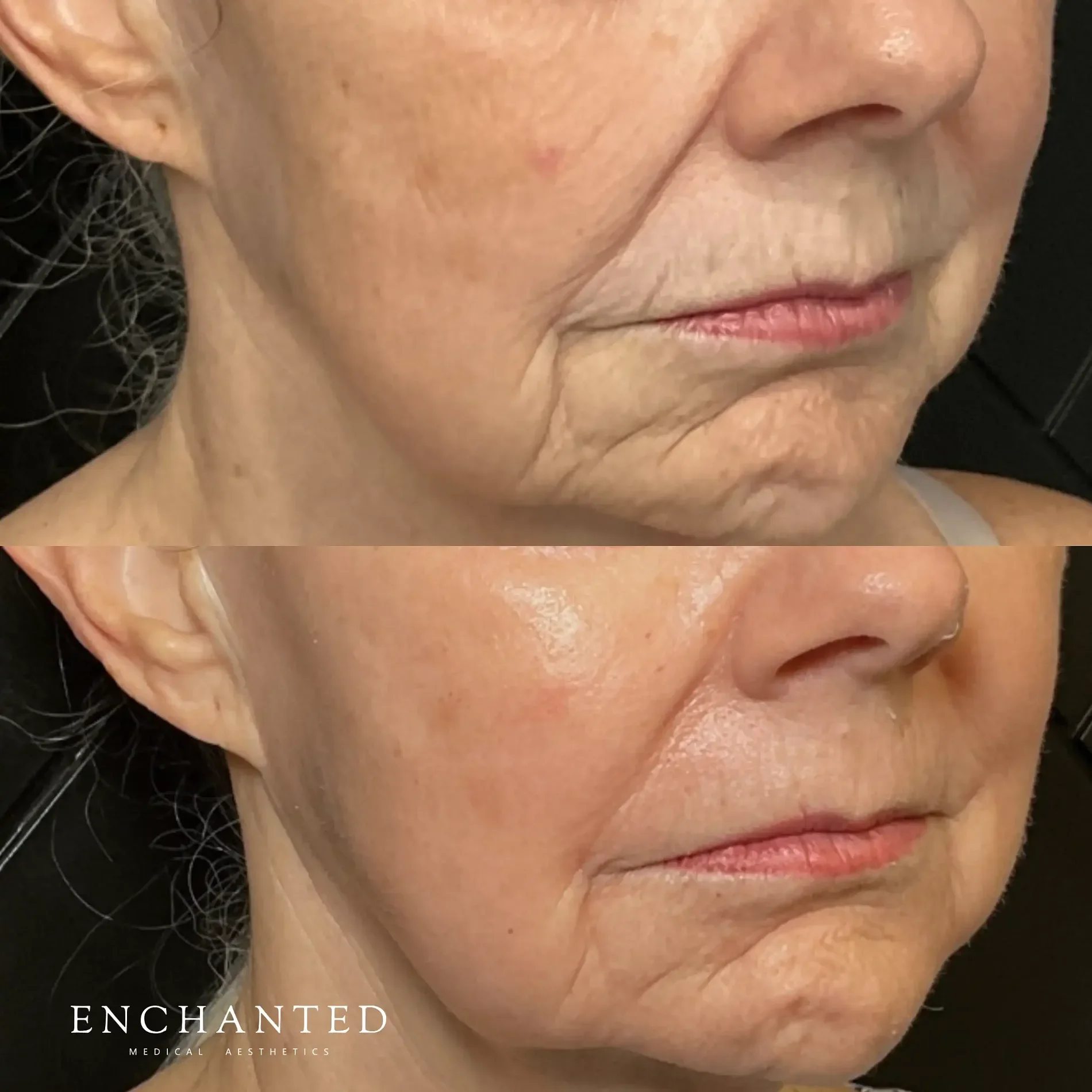 Helix Before and After By Enchanted Medical Aesthetics five