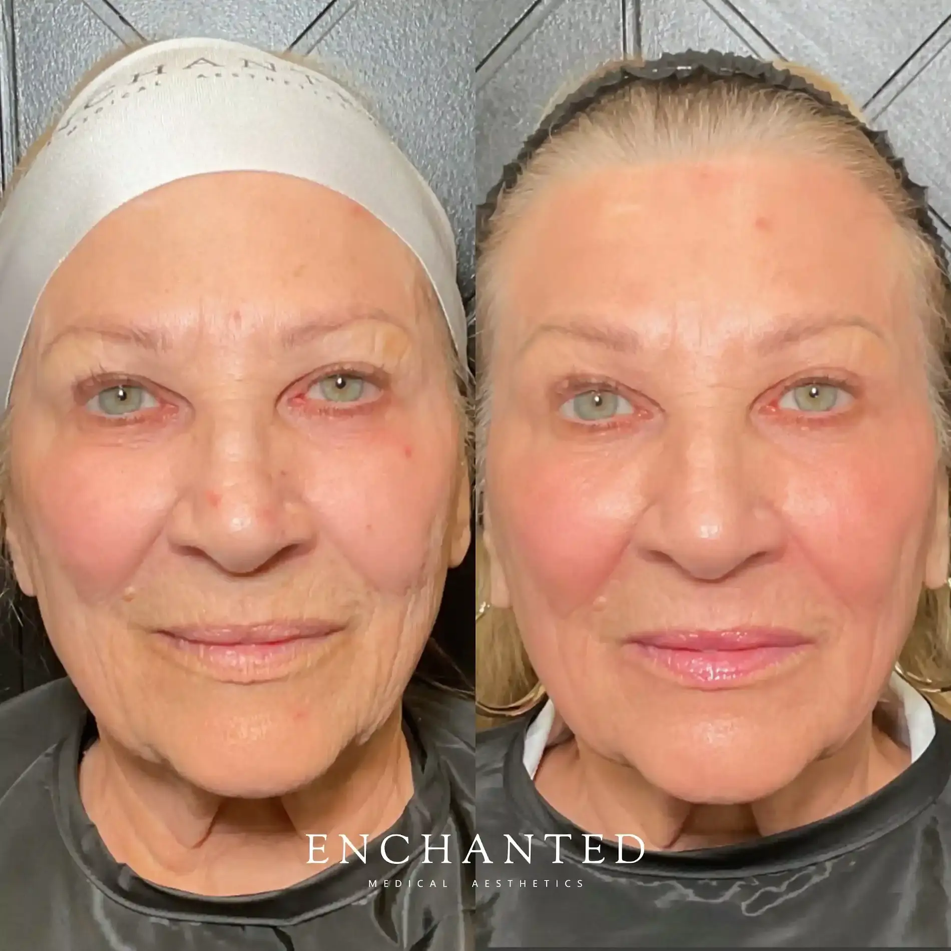 Helix Before and After By Enchanted Medical Aesthetics one