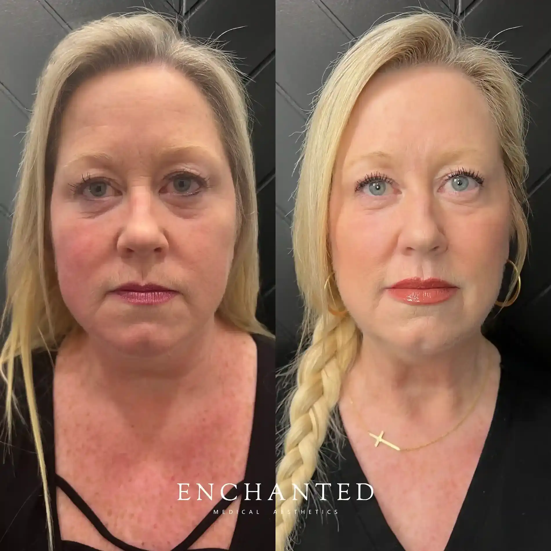 Helix Before and After By Enchanted Medical Aesthetics three