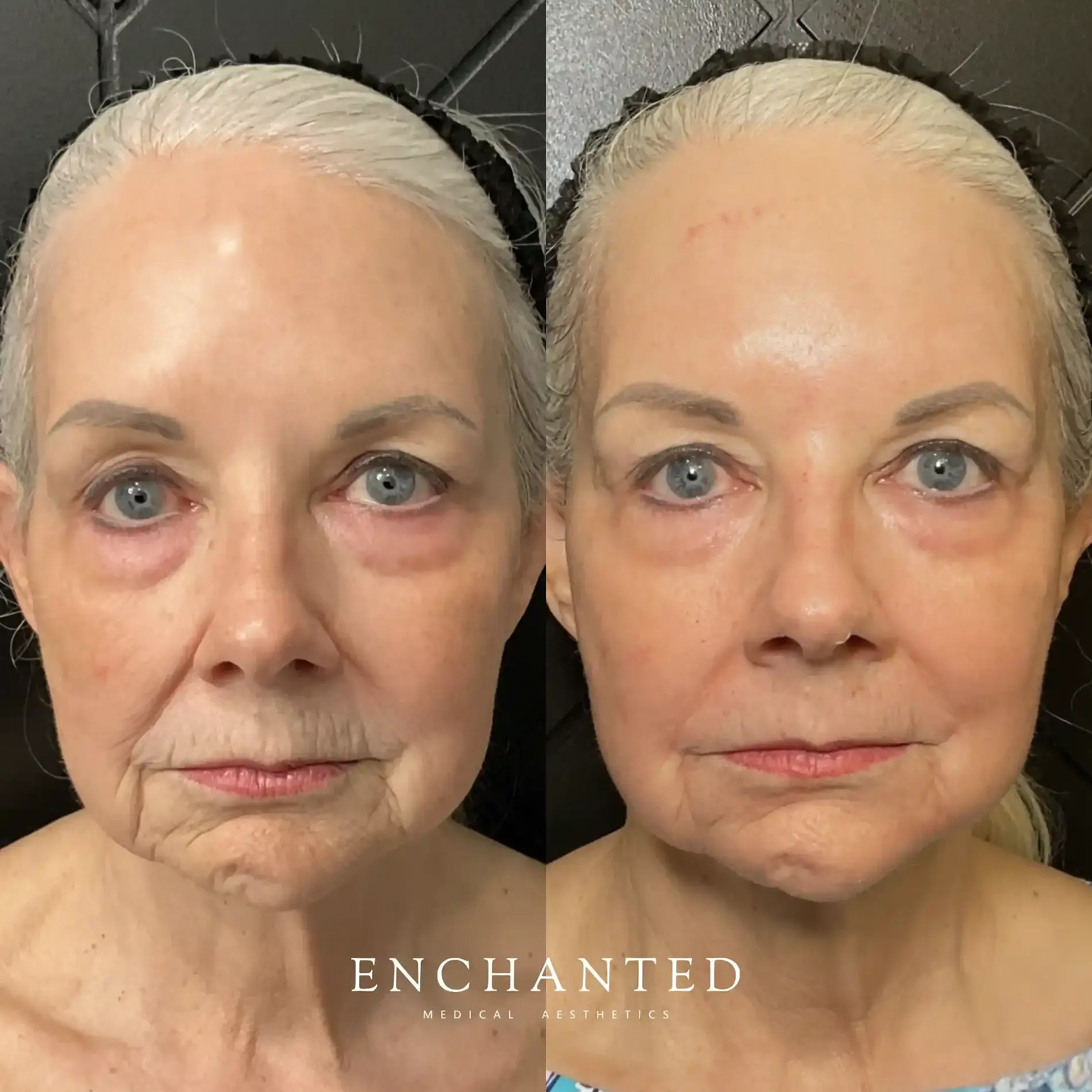 Helix Before and After By Enchanted Medical Aesthetics two