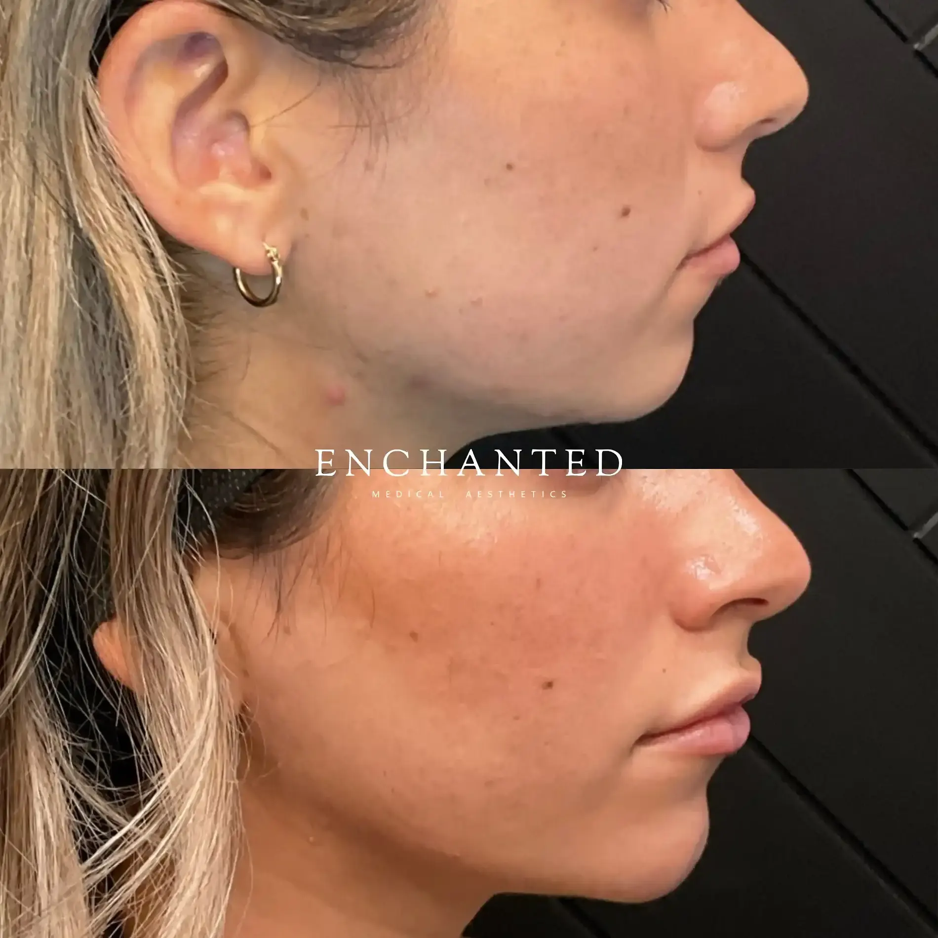 Lip Filler Before and After By Enchanted Medical Aesthetics five