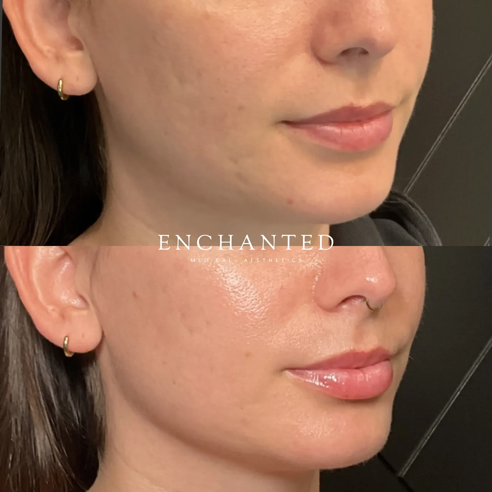 Lip Filler Before and After By Enchanted Medical Aesthetics four