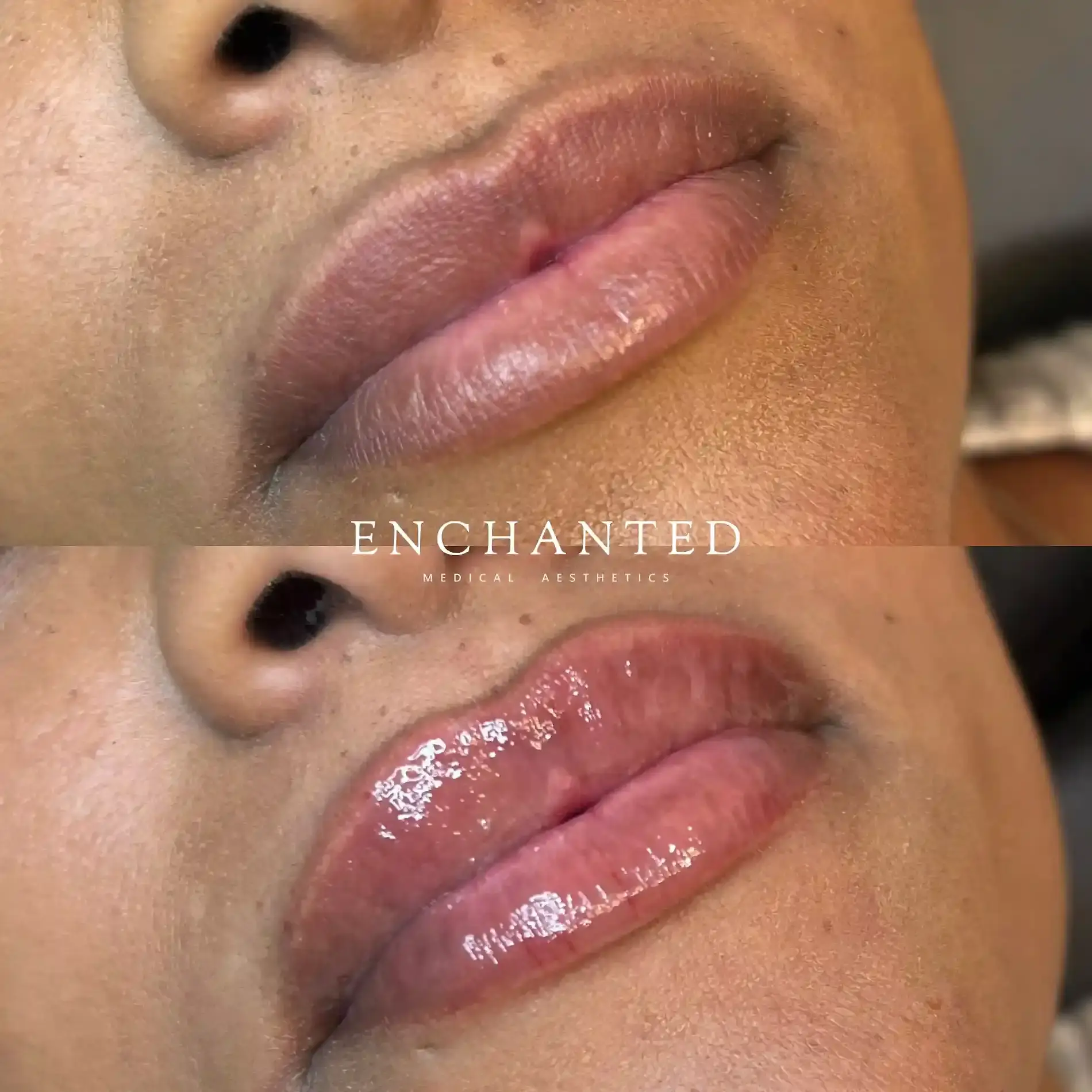 Lip Filler Before and After By Enchanted Medical Aesthetics one