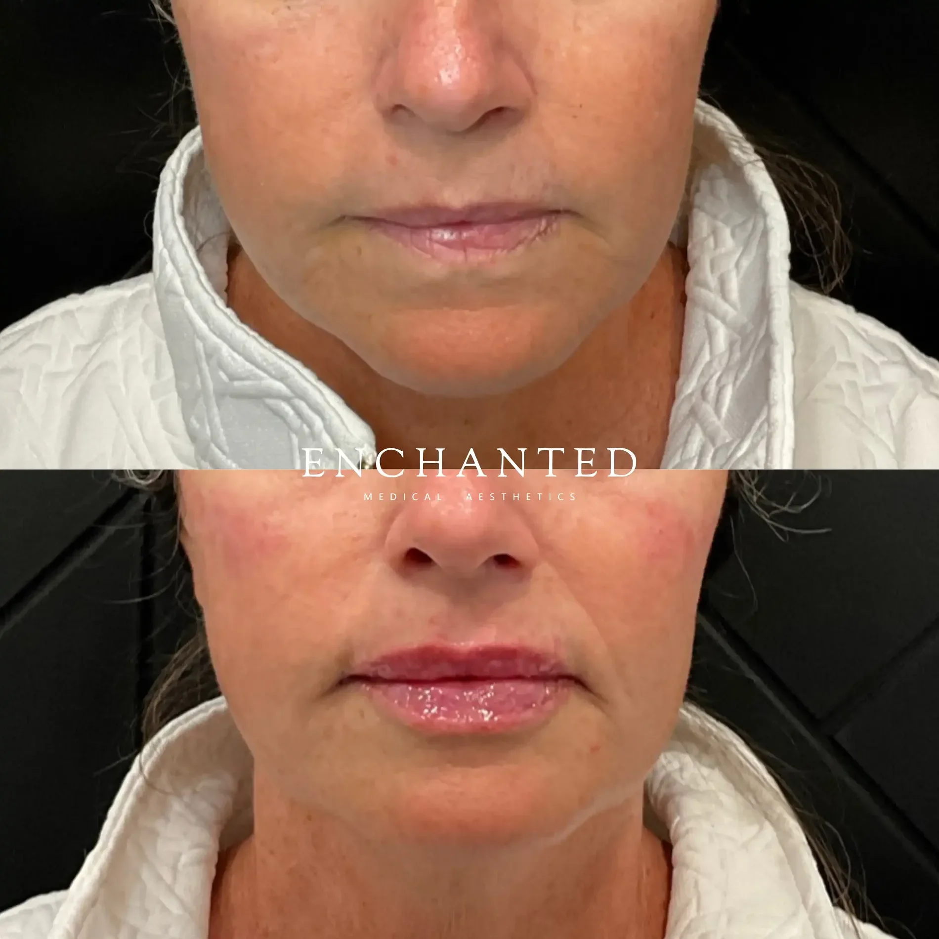 Lip Filler Before and After By Enchanted Medical Aesthetics seven