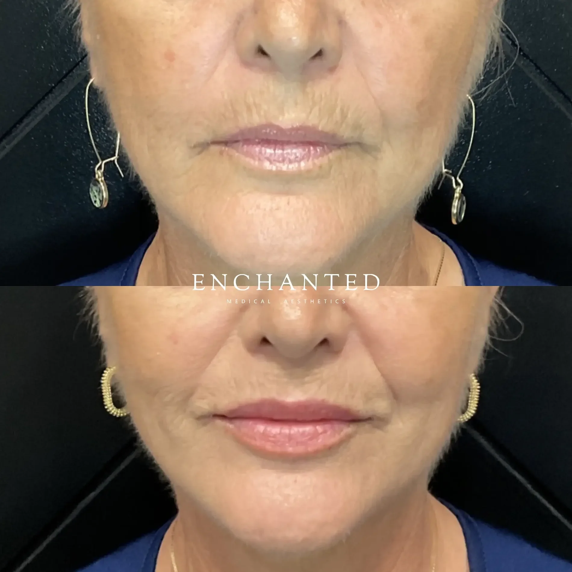 Lip Filler Before and After By Enchanted Medical Aesthetics six