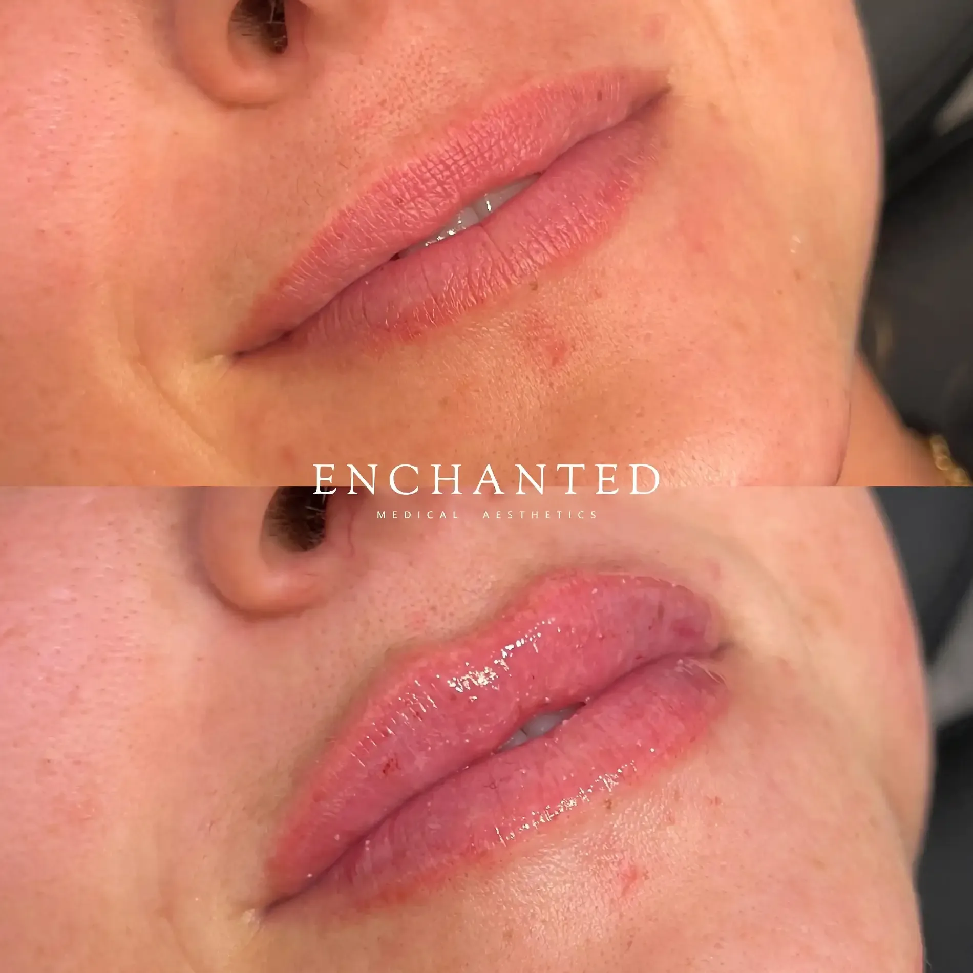 Lip Filler Before and After By Enchanted Medical Aesthetics three