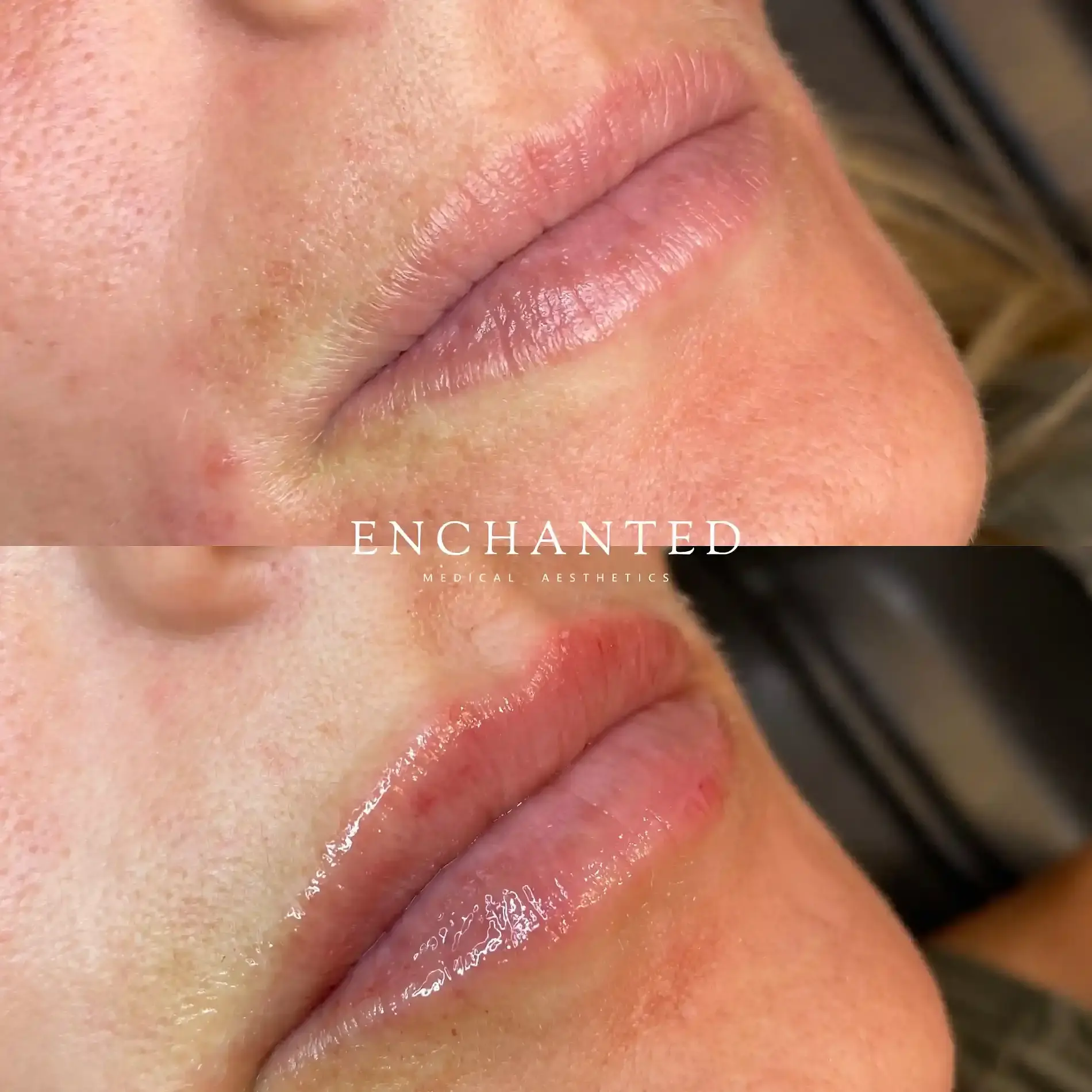 Lip Filler Before and After By Enchanted Medical Aesthetics two