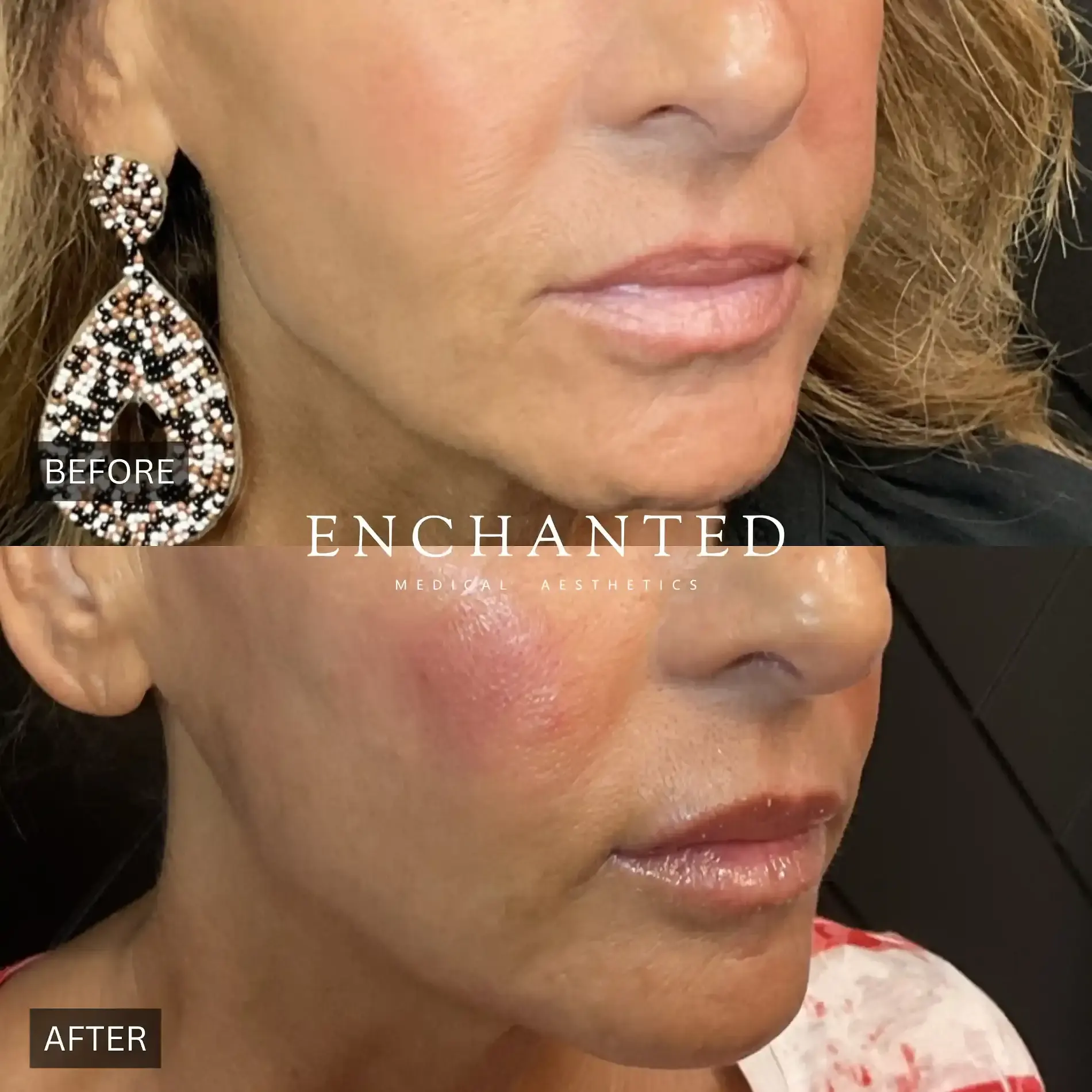 Skinvive Before and After By Enchanted Medical Aesthetics one