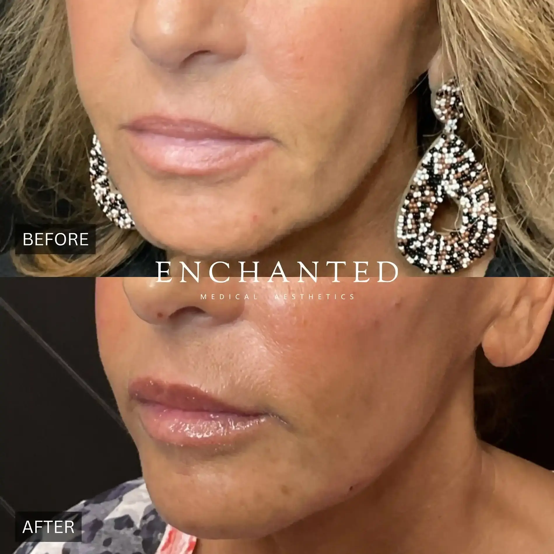 Skinvive Before and After By Enchanted Medical Aesthetics two