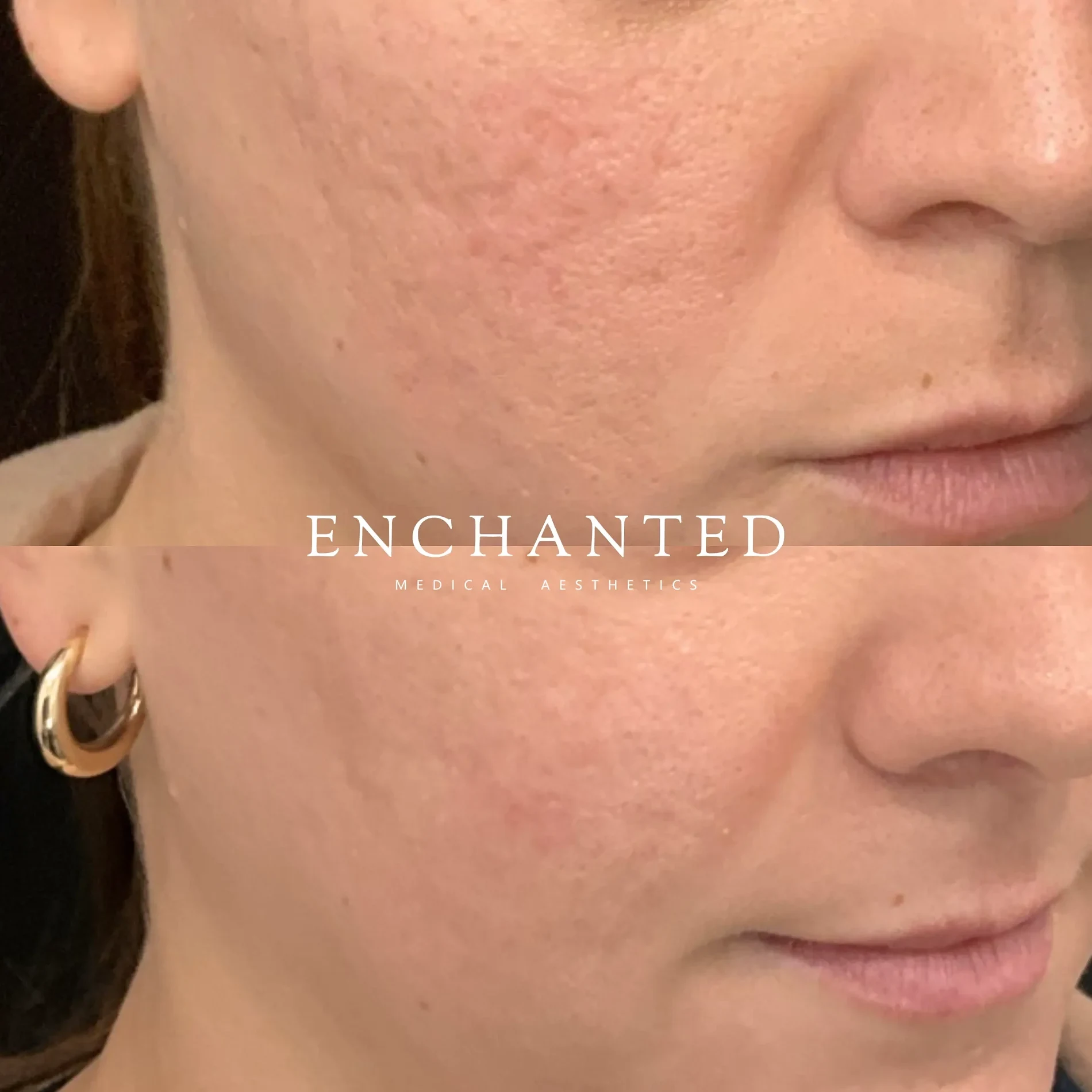 Tetra CO2 CoolPeel Treatments Before and After By Enchanted Medical Aesthetics one
