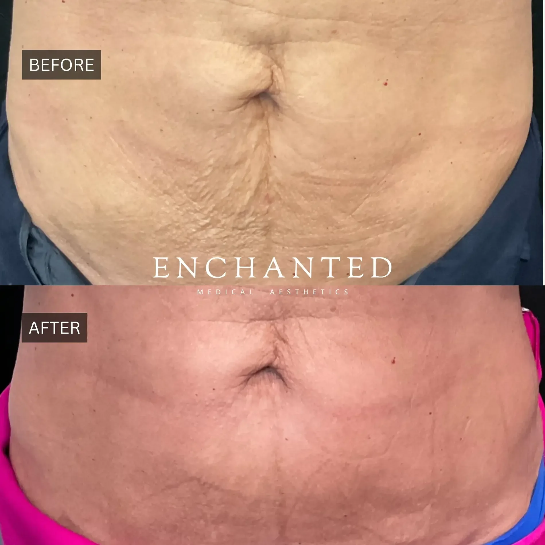 Thread Lift Before and After By Enchanted Medical Aesthetics one