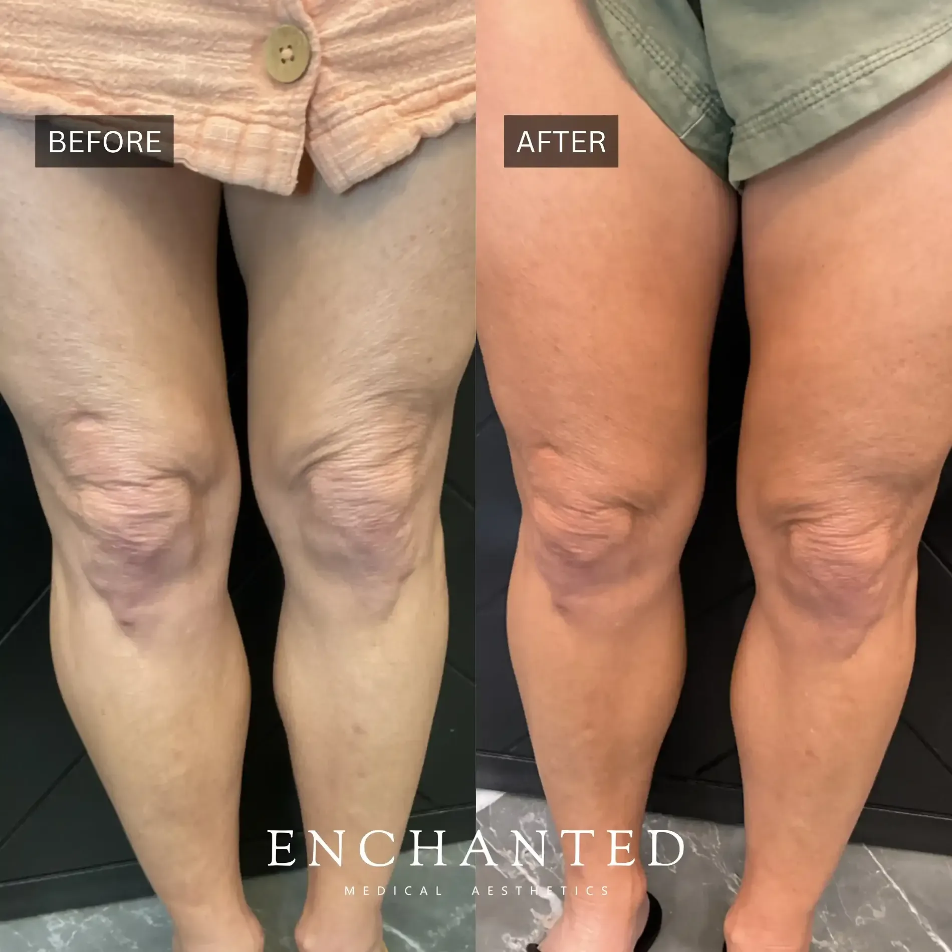 Thread Lift Before and After By Enchanted Medical Aesthetics two