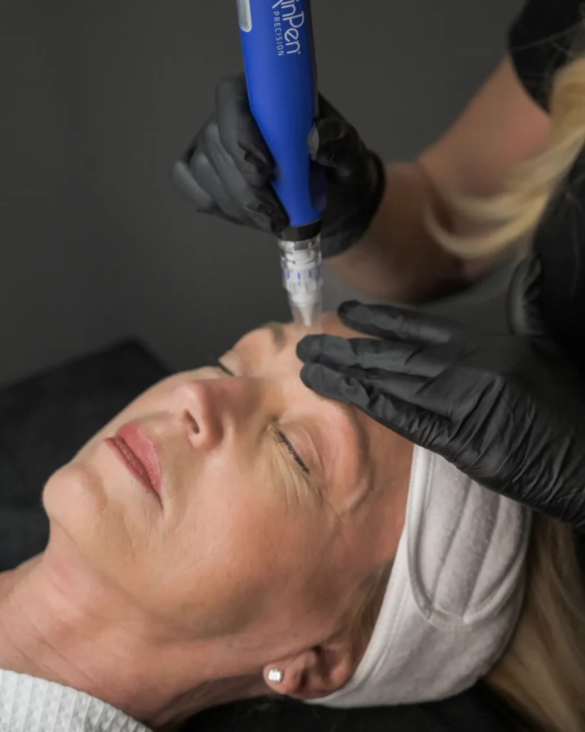 Body Microneedling with PRF and PRP