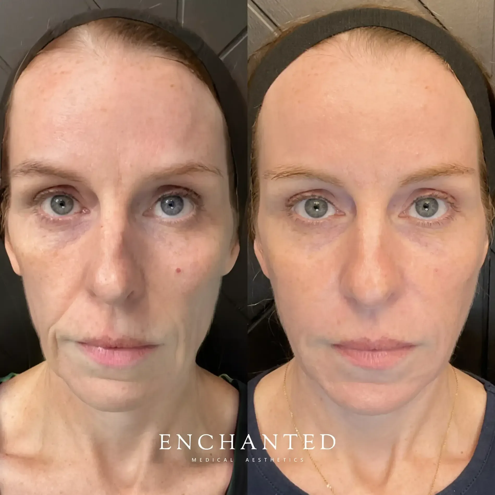 Cheek Filler Injections at Enchanted Medical Aesthetics FAQ section before and after image one