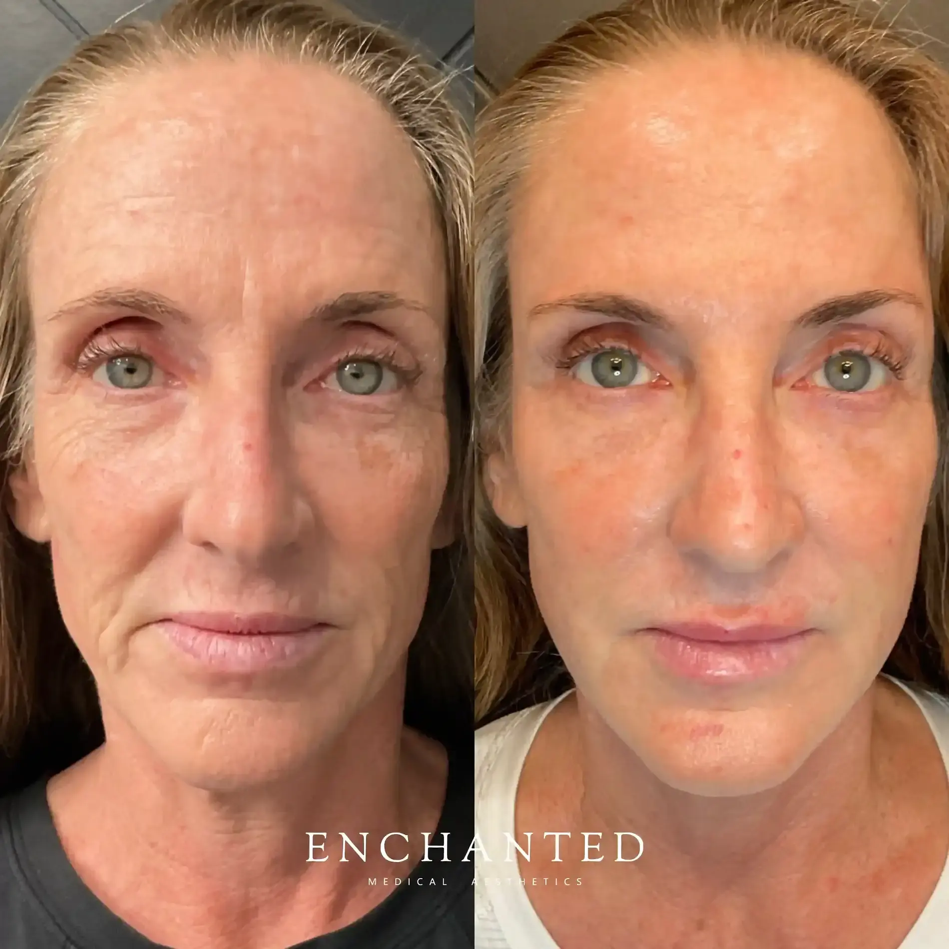 Cheek Filler Injections at Enchanted Medical Aesthetics FAQ section before and after image three