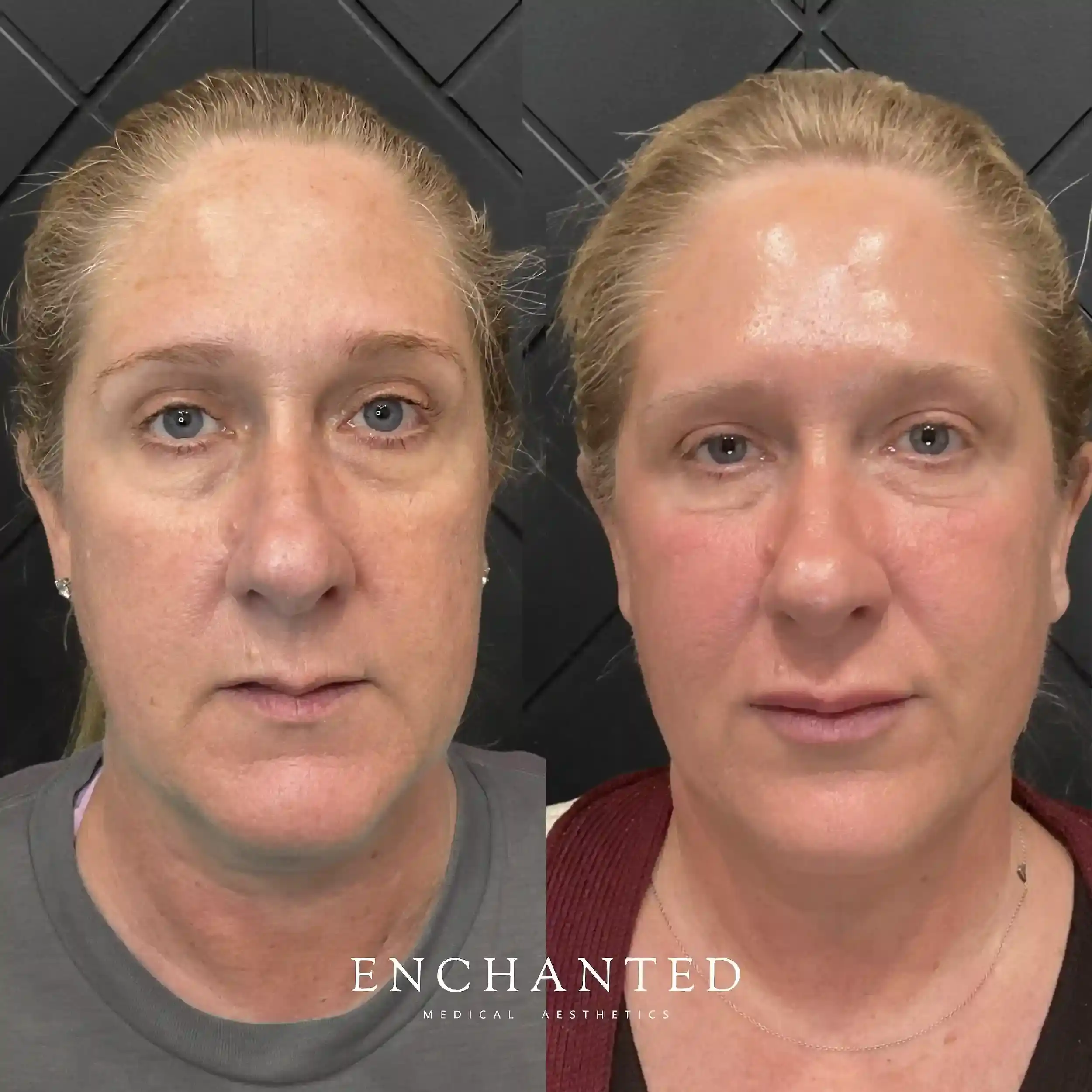 Cheek Filler Injections at Enchanted Medical Aesthetics FAQ section before and after image two