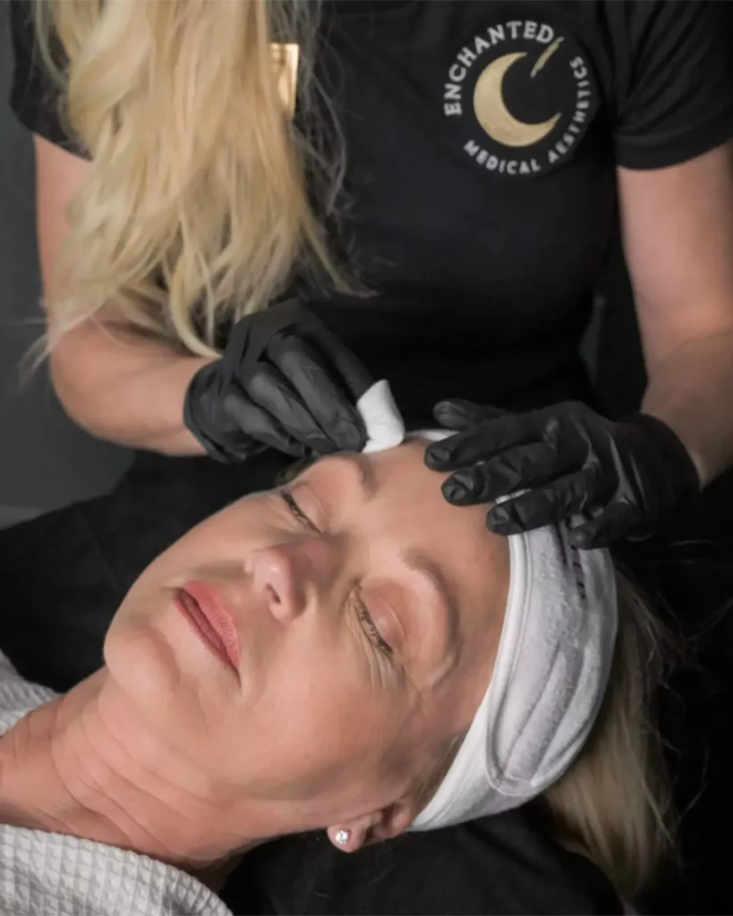Chemical Peel