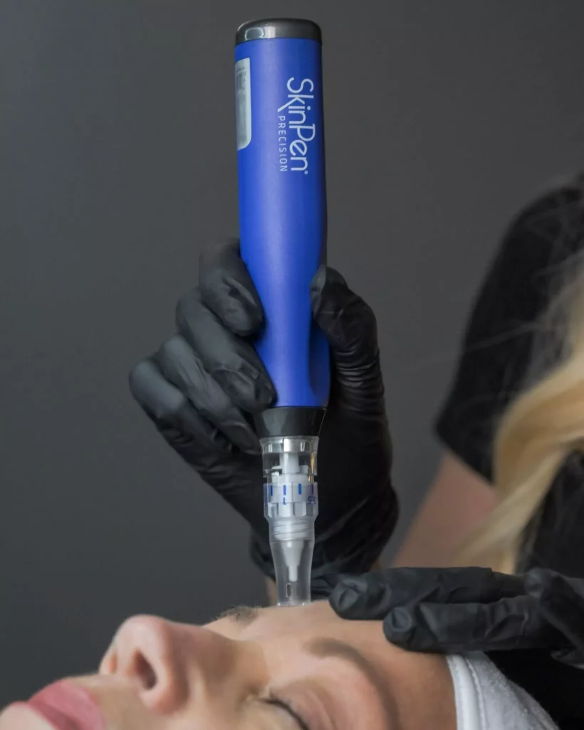Microneedling