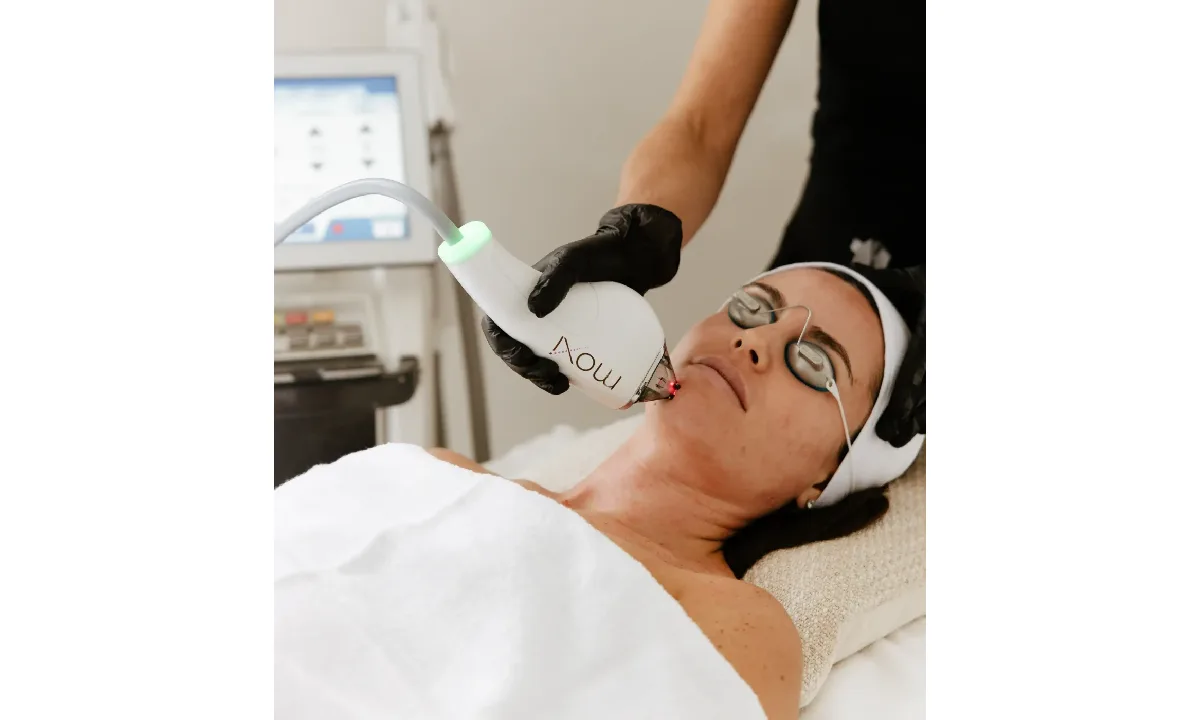 MOXI laser treatment for post-summer skin rejuvenation