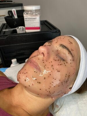 Hydrojelly Mask Facial By Enchanted Medical Aesthetics