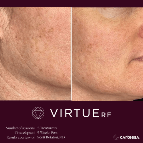 Virtue RF Microneedling Before and After By Enchanted Medical Aesthetics