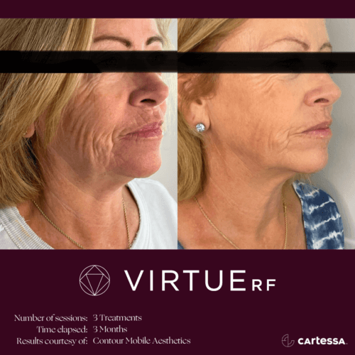 Virtue RF Microneedling Before and After By Enchanted Medical Aesthetics