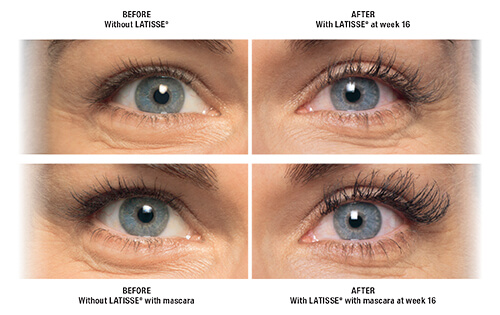 Latisse Before and After By Enchanted Medical Aesthetics