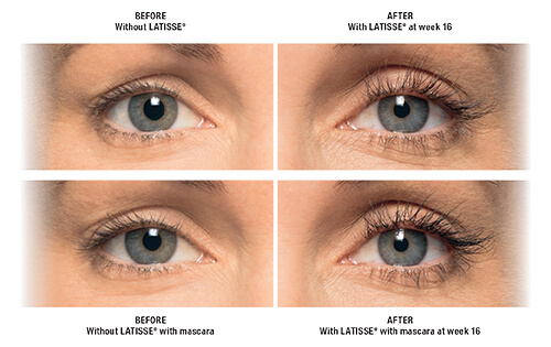 Latisse Eye Treatment Before and After By Enchanted Medical Aesthetics