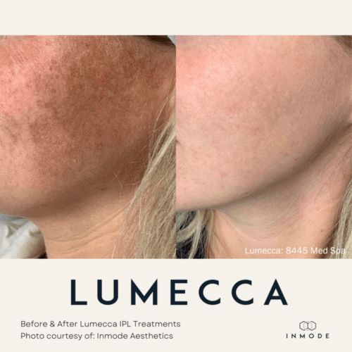 Lumecca IPL Treatment Before and After By Enchanted Medical Aesthetics