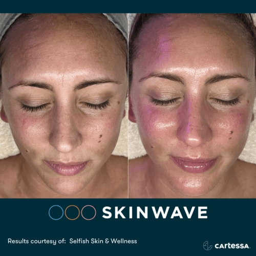Skinwave Before And After By Enchanted Medical Aesthetics
