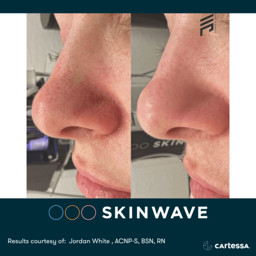 Skinwave Before And After By Enchanted Medical Aesthetics