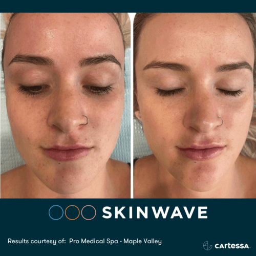 Skinwave Before And After By Enchanted Medical Aesthetics