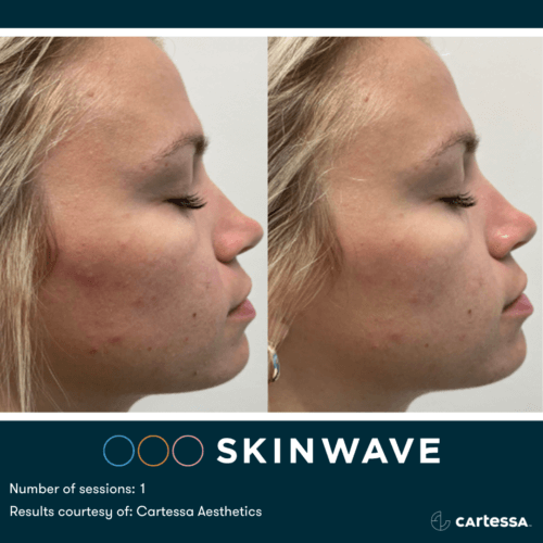 Skinwave Before And After By Enchanted Medical Aesthetics