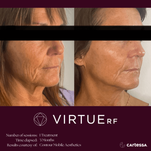 Virtue RF Microneedling Before and After By Enchanted Medical Aesthetics